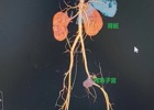 省医帮扶丨全县首例！县人医微创解决青春期残角子宫患者的“难忍之痛”