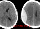 小撞成大患！佛冈人医神经外科绿色通道救治重型颅脑创伤患者