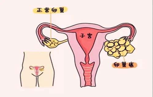 健康科普丨沉默的杀手—“妇癌之王”卵巢癌 你了解多少？