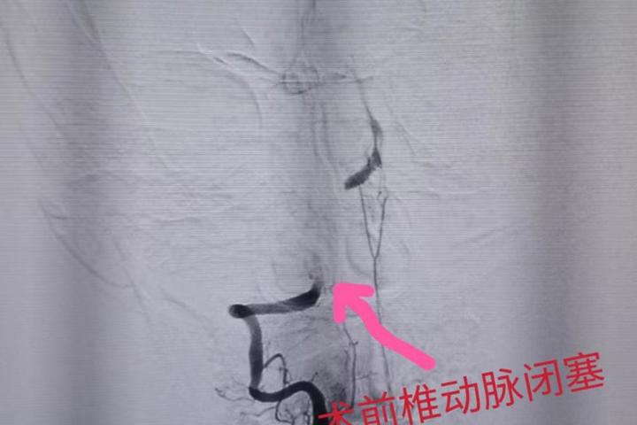 家中“顶梁柱”突然倒下！佛冈人医与死神赛跑介入取栓夺回生机