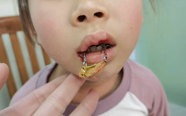 鱼钩飞入口中 女童嘴唇被“咬”！佛冈人医医生提醒：千万别硬拉