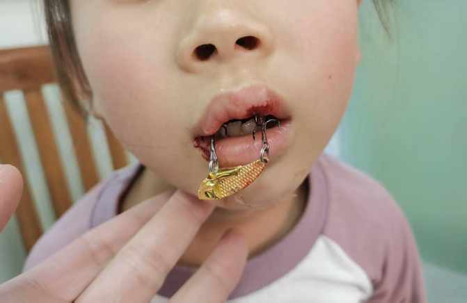 鱼钩飞入口中 女童嘴唇被“咬”！佛冈人医医生提醒：千万别硬拉