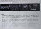 让患者免受插管之苦 佛冈人医肾内科经PTA快速开通患者自体内瘘