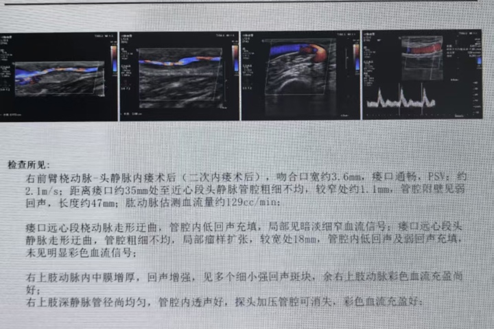 让患者免受插管之苦 佛冈人医肾内科经PTA快速开通患者自体内瘘
